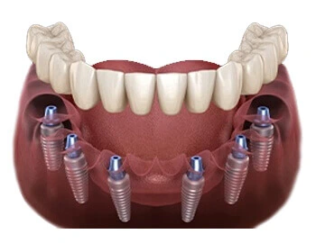 Dental Clinic in Athipalayam Pirivu