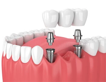 Best Implant treatment in Maniyakarampalayam
