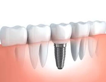Implant Treatment near FCI Road
